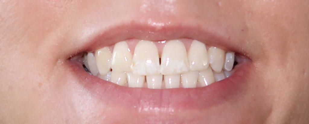 Rapid white Bleaching System - Zähne vorher